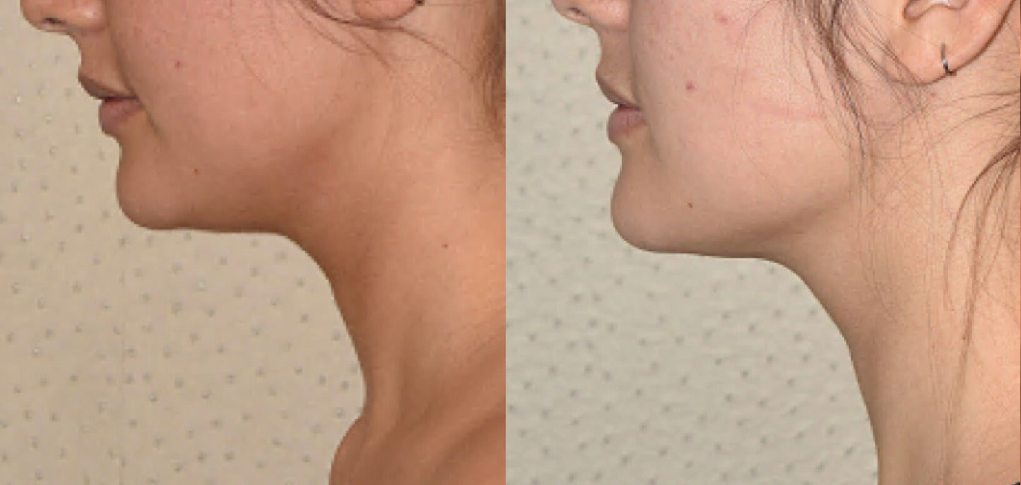 DrenaFace – Escova de Drenagem Linfática Facial