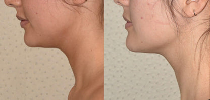 DrenaFace – Escova de Drenagem Linfática Facial